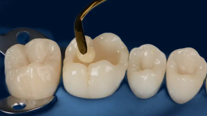 A dental tool is placing a filling into a ceramic tooth model, with several other tooth models displayed beside it.