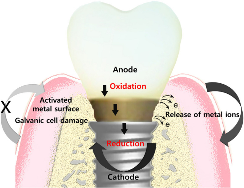 Symptoms of Oral Galvanism